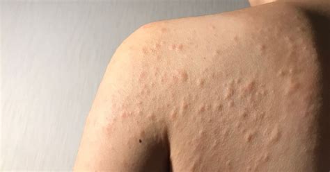 continuously  hives common   urticaria