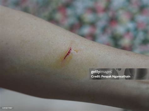 knife cuts  arm