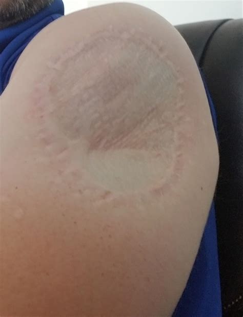 So I have this mighty scar on my shoulder. I'm working on the opposite