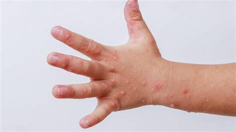 Hand, Foot, And Mouth Disease: An Overview, 50% OFF