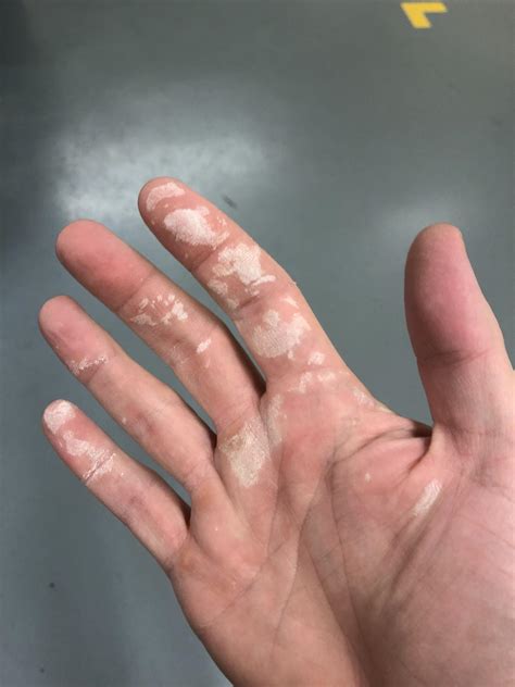 This isn’t paint it’s dead skin because I forgot to wear gloves when