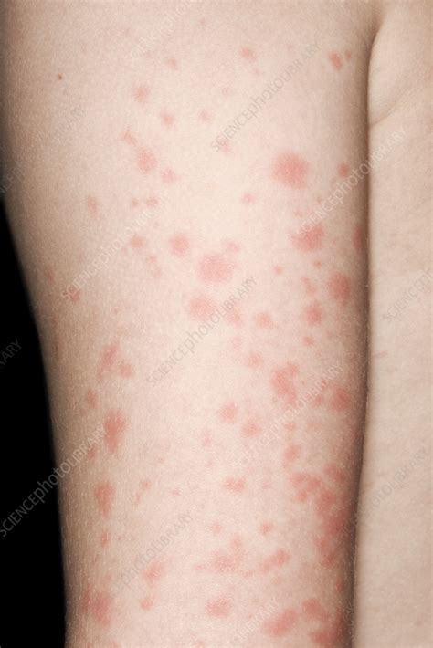 hives stock image  science photo library