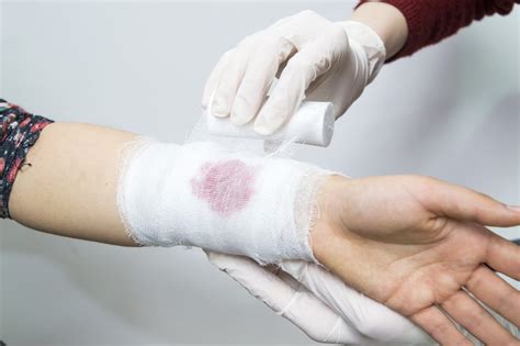 Providing First Aid While Venous and Capillary Bleeding - fitness and ...