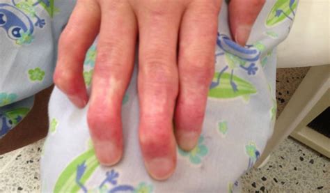 ¿Esclerodermia? - NTR Zacatecas