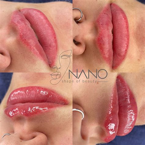 Hyaluron Pen Fillers in Stuart & Delray Beach | Needle-Free Lip Enhancement