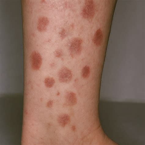diabetic skin conditions visual guide pictures