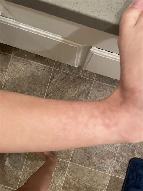 Anyone know what this is? It’s on both ankles and doesn’t hurt. : r