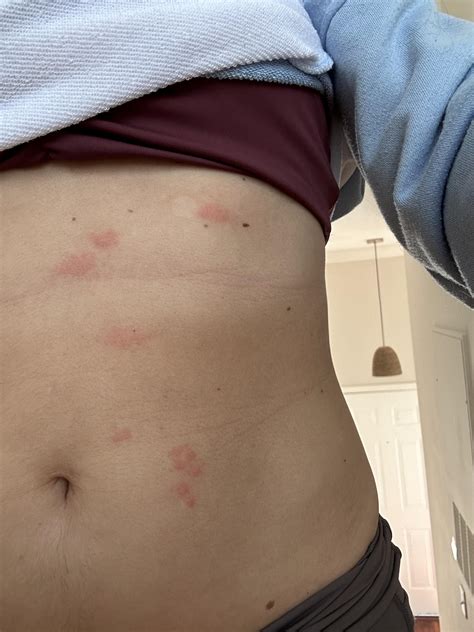 Rash On Stomach Not Itchy Treatment at Marsha Shain blog