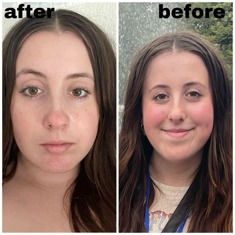 3 months post operation of double jaw surgery and genioplasty, I can’t