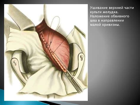 Резекция желудка - online presentation