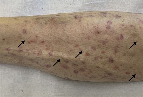 limb ecchymosis   man   history  alcohol misuse  bmj