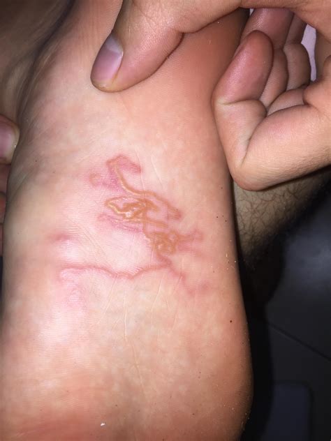 Cutaneous Larva Migrans, contracted in Indonesia and treated in