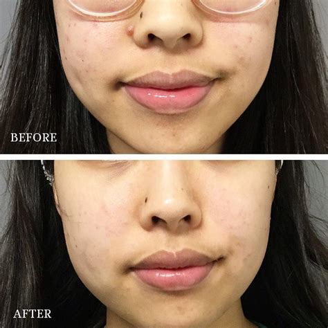 acne treatment ultimate aesthetics