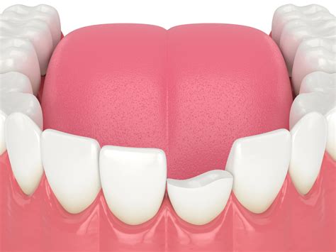 Repairing A Chipped Or Broken Tooth - Health BeatHealth Beat