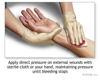 The New York Times > Health > Image > Stopping Bleeding With Direct ...