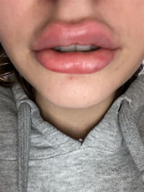 Is this normal swelling? 1M versa 6 hours ago... feel like they are