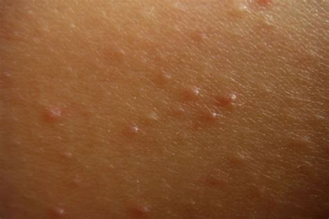 Raised Skin Bumps: Causes (With Pictures) and Treatment