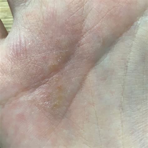 Eczema (ICD-10: L20-L30) - Online consultation AI dermatologist