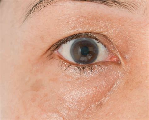 Bags Under Eyes Women