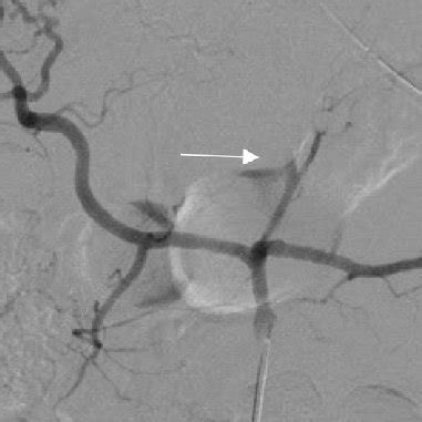 e Angiography from the celiac trunk after coiling of the gastrohepatic ...