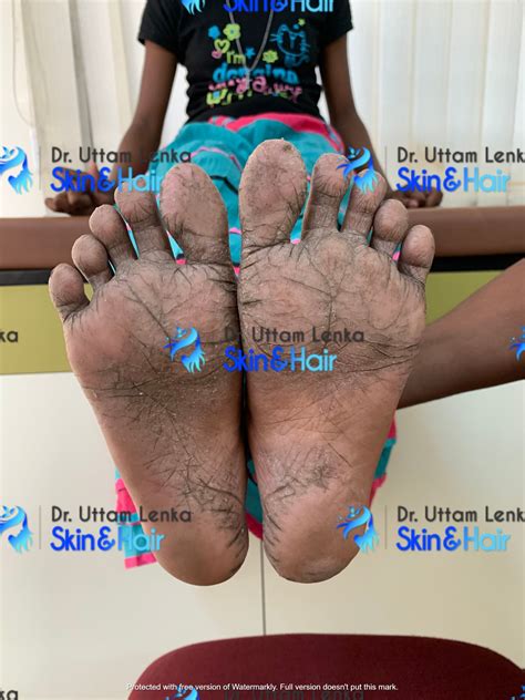 Gallery (Advanced Diagnosis and Treatment) - Dr. Uttam Lenka's Skin