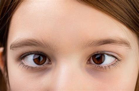 amblyopia  strabismus whats  difference ottawa