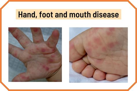 Blister on Lip: Cold Sores and 13 Other Causes (with Pictures)