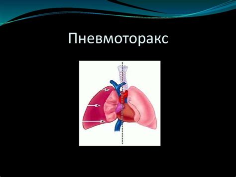 Пневмоторакс: клиника и диагностика - презентация онлайн