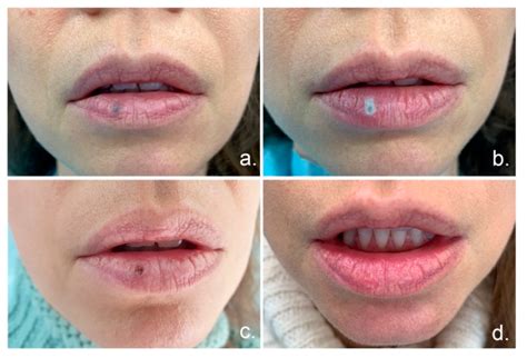 Venous Lake Lip