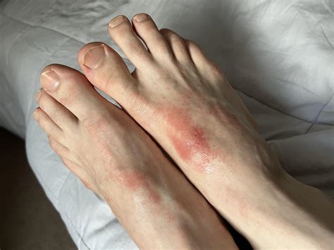 Rash From Leather Shoes at Alice Hager blog