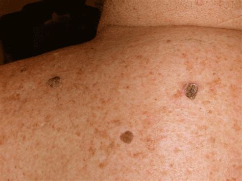 Seborrheic Keratosis Or Black Spots Laser Skin Seborrheic Keratosis ...