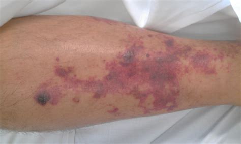 reasons  purpura