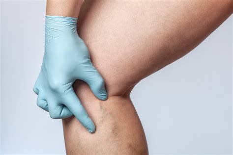 What is chronic venous insufficiency? Symptoms and treatment after