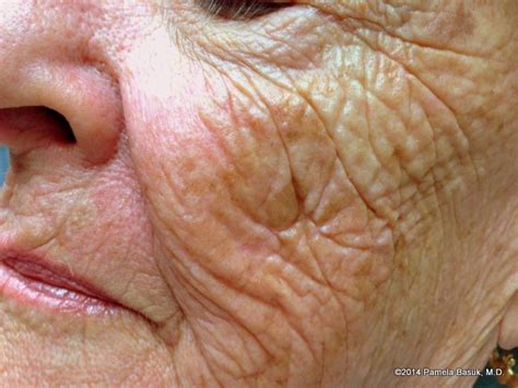 Aging Skin – BASUK DERMATOLOGY