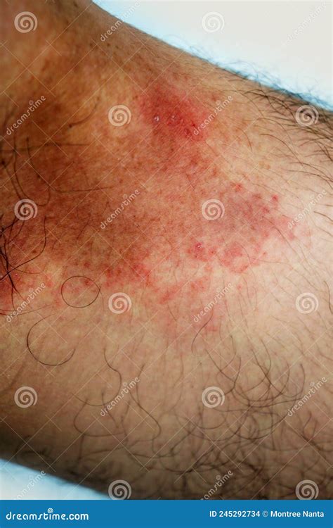 itchy rash   groin area tinea cruris   type  skin disease