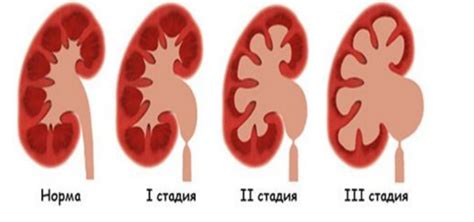 Гидронефроз почки: причины, степени и стадии, симптомы, лечение