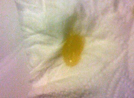 Coughing up Phlegm - Sputum Colors, Causes and Treatment