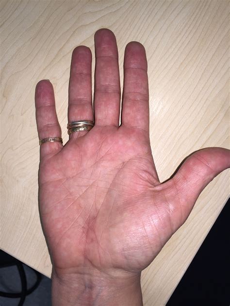 Carpal Tunnel Surgery Scar