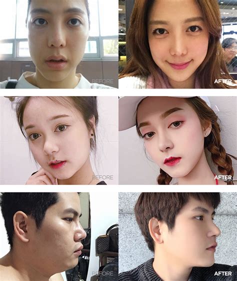 non surgical procedures for face 9