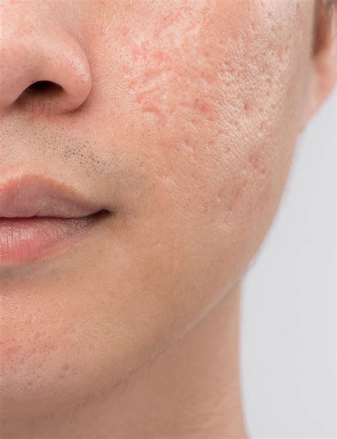 Acne scars - acne-solutions