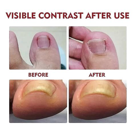 Anti Paronychia Relief Oil, Anti-paronychia Auxiliary Oil, Ingrown