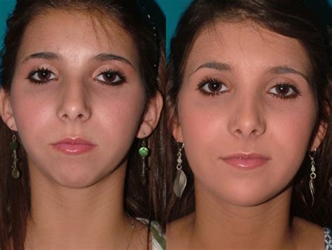 chin augmentation    gallery cc plastic surgery