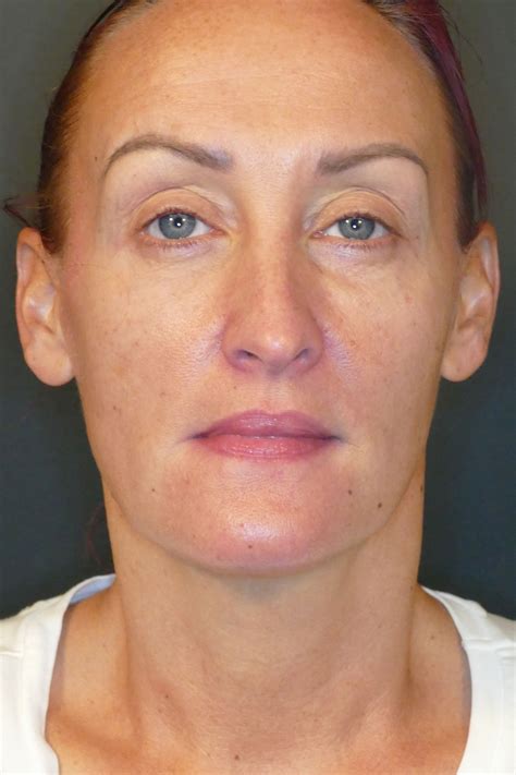 Laser Treatments Before & After Photos | Adoro Medical Spa