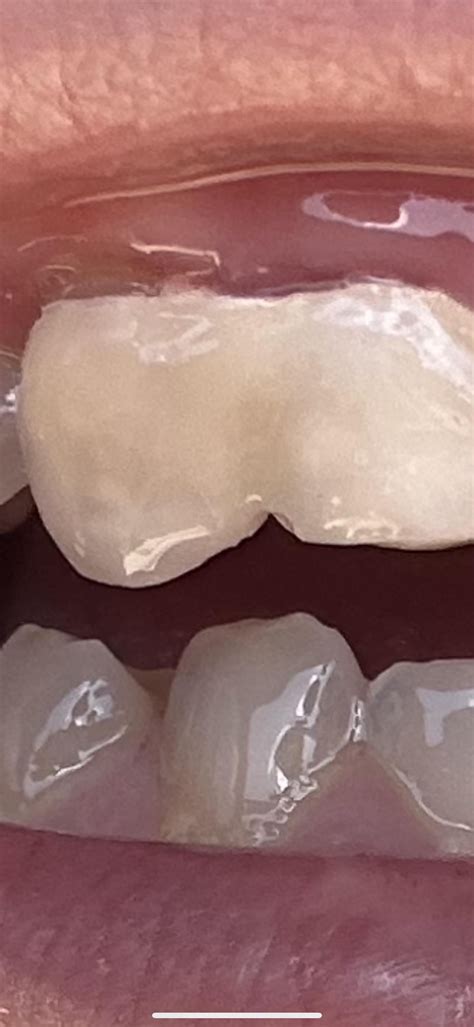 Are temporary crowns supposed to be like this? : r/DentalHygiene