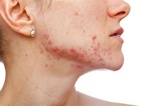 Viral di TikTok, Begini Penjelasan Dermatolog Soal Spearmint Tea yang ...