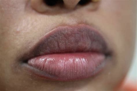 lighten  dark lips top natural treatments  work