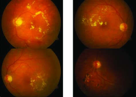images  symptoms   levels  exudates