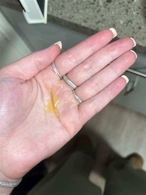 fluid leaking out of nose?? : r/medical