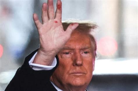 "Це виглядає як сифіліс": Журналісти помітили у Трампа ознаки ...