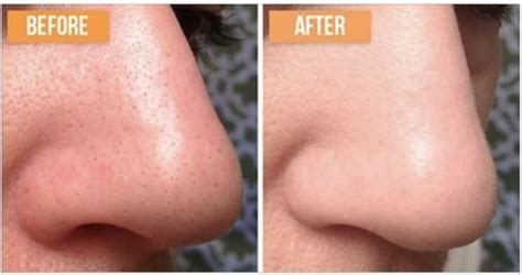 how to get rid of open pores on face